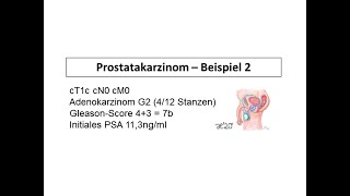 Beispiel 1 für die Behandlung eines Prostatakarzinoms  Strahlentherapie Prof Hilke Vorwerk [upl. by Alhsa]