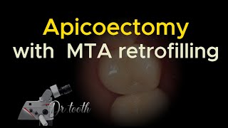 Apicoectomy with retrograde MTA filling 치근단 절제술 [upl. by Ailehs]