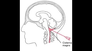 Mnemonics to remember structures pierced during Cisterna Puncture or Cisternal puncture [upl. by Adekahs44]