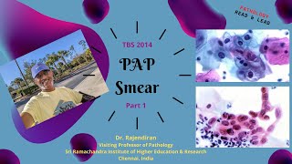 PAP smear Part 1 [upl. by Philipines921]