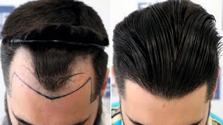 FUT Hair Transplant Strip Harvesting [upl. by Follmer]