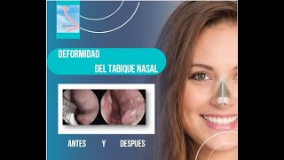 DESVIACIÓN DEL TABIQUE NASAL ANTES Y DESPUES [upl. by Akirdnwahs524]