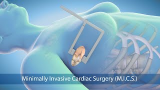 Medical Animation Minimally Invasive Cardiac Surgery MICS at Sarasota Memorial Hospital [upl. by Nannerb943]