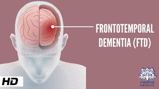 Frontotemporal Dementia Causes Signs and Symptoms Diagnosis and Treatment [upl. by Trudy]