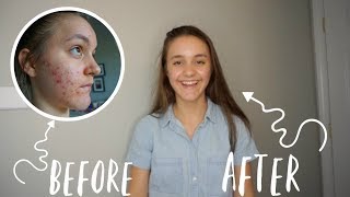 HOW TO GET RID OF ACNE  One month on Doxycycline [upl. by Lanni]