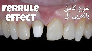 ferrule effect شرح كامل بالعربي لل [upl. by Notrab]