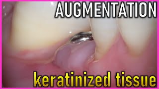 AUGMENTATION of keratinized tissue on IMPLANT [upl. by Karee186]