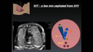 Three Vessel Tracheal View A Review of Normal and Abnormal Findings [upl. by Sashenka]