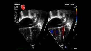 Congenital Heart 💕 Defect PDA PFO vs ASD [upl. by Elicec]