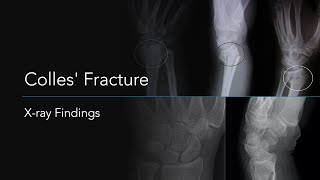 Colles Fracture Xray Findings [upl. by Adlee]