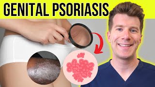 Doctor explains GENITAL PSORIASIS  Causes symptoms and TREATMENT [upl. by Madelin74]