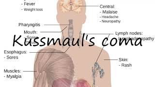 How to Pronounce Kussmauls coma [upl. by Acnairb]