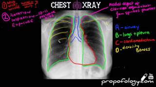 LEARN to Read a Chest Xray in 5 minutes [upl. by Lotsyrk]