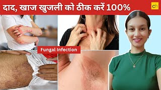 Fungal Infection क्या होता है Causes Symptoms and Treatment  Credihealth [upl. by Anoiuq]