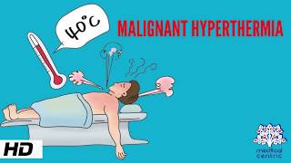 MALIGNANT HYPERTHERMIA Causes Signs and Symptoms Diagnosis and Treatment [upl. by Michal755]