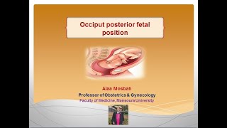 Occiput posterior fetal position [upl. by Panter230]