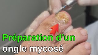 Mycose  Préparation de longle par le PédicurePodologue [upl. by Allyson]