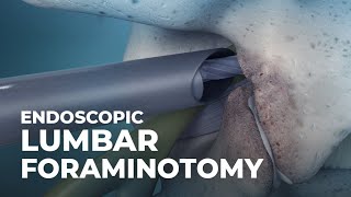 What is Endoscopic Lumbar Foraminotomy  Atlantic Spine Center [upl. by Aisilef]