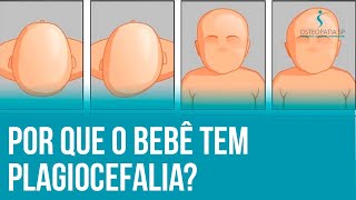 Por que o bebê tem plagiocefalia [upl. by Hanaj72]