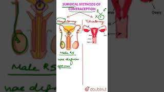 Surgical Contraception Vasectomy vs Tubectomy [upl. by Aleta]