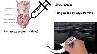 Most common thyroid cancer  Papillary thyroid carcinoma symptoms treatment and prognosis [upl. by Proulx]