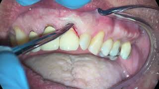 Anterior Incisor Extraction Due to Persistent Apical Periodontitis [upl. by Aicatan]