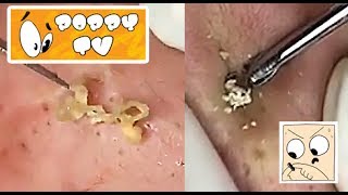 Large Closed Comedones  Whiteheads Extraction [upl. by Ybba]