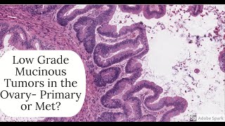 Digital Surgical Pathology 392 Mucinous ovarian tumor Primary or Met [upl. by Eelessej]