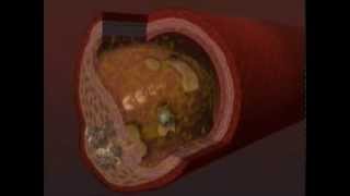 Chelation Therapy Video [upl. by Atsev339]