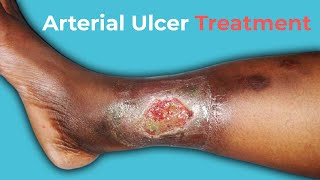 What Are Arterial Ulcers Arterial Ulcer Treatment [upl. by Assirehc326]