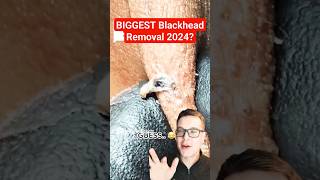 Stunning HUGE BLACKHEAD REMOVAL  Biggest Blackhead 2024 shorts [upl. by Liemaj]