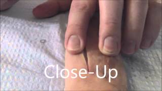 How to Close a Wound in Seconds With Surgical Staples [upl. by Redd]