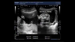 Anencephaly with a pregnancy of about 22 weeks 3 weeks [upl. by Jemimah243]