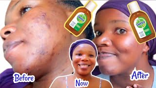 How to use DETTOL Antiseptic Liquid to clear acne How to get rid of pimples with Dettol [upl. by Adnoral200]