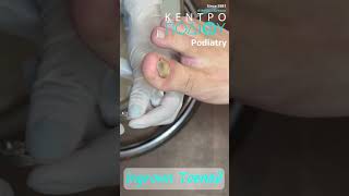 Ingrown Toenail κεντροποδιου kentropodiou podiatry podiatria podologia podology podiatrist [upl. by Rapsac]