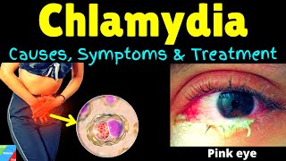 Chlamydia  Symptoms Causes Pathophysiology Diagnosis Treatment Complications [upl. by Cita]