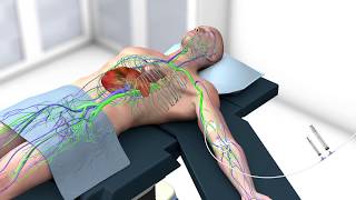 Using ICG with the 1588 AIM Platform and ENV Mode in Laparoscopic Cholecystectomy [upl. by Vasilis]