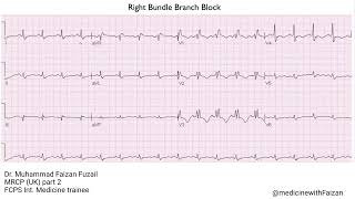 Right Bundle Branch Block RBBB pattern [upl. by Sabah]