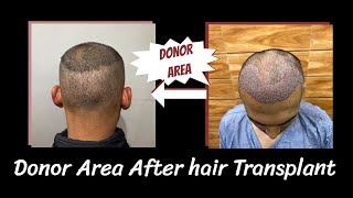 quotHair Transplant Donor Area Reveal Healing Progress amp Resultsquot hairtransplant meesho seller [upl. by Holman]