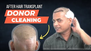 Donor Area After Hair Transplant  Hair Transplant Journey  Donor Area Condition  Hairmate Pune [upl. by Madeleine639]