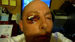 3 Days After My Eye Removal Surgery ENUCLEATION [upl. by Aidualk834]