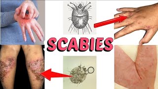 Scabiessymptoms causes treatment urduhindi [upl. by Duomham154]