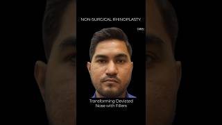 Deviated nose reshaping with non surgical rhinoplasty nonsurgicalrhinoplasty [upl. by Ettenwahs417]