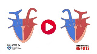 Transposition of the great arteries TGA  causes symptoms treatment amp pathology [upl. by Nwahsirhc]