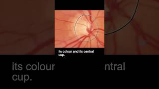 Examining the fundus – part 2 ophthalmology [upl. by Ari]