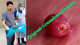 pyogenic granuloma treatment Pyostomatitis VegetansBacterial Infection Of The Oral Cavity [upl. by Asenab]