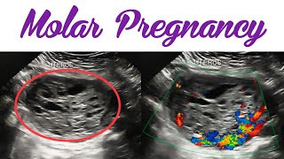 Molar Pregnancy on Ultrasound  Gestation Trophoblastic Disease  Complete Hydatidiform Mole [upl. by Ardnekat]