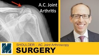 Shoulder  AC joint Arthritis [upl. by Carolan393]