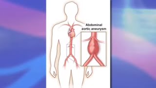 Risks and Benefits of Endovascular Abdominal Aortic Aneurysm Repair EVAR [upl. by Phillipp]