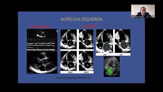 Ecocardiografia en la predicción de embolismo y recurrencia de la FA  Carlos Javier Ramirez [upl. by Ciccia831]